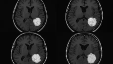 Revolutionary MRI Detects Tiny Cancer Traces in Myeloma Patients