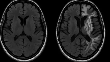 What Are the MRI Signs of MPV17 Mitochondrial Syndrome?