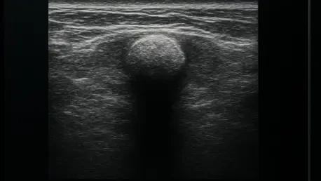 How Can Ultrasound Detect Botfly Larvae After Travel?